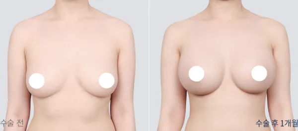 Before/After