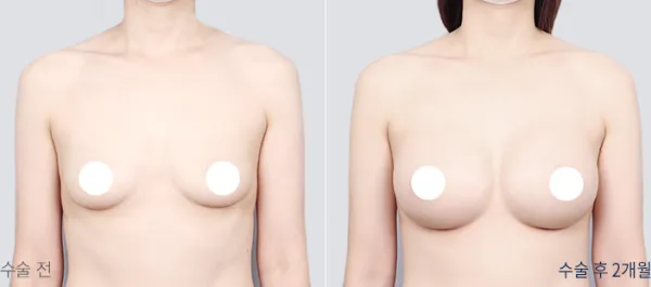Before/After