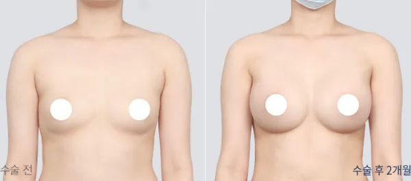 Before/After