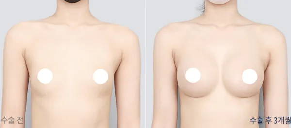 Before/After