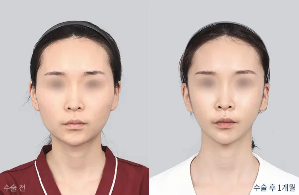 Before/After