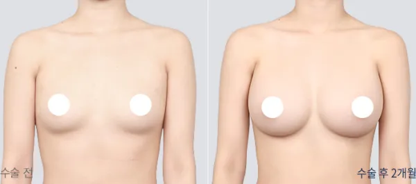 Before/After