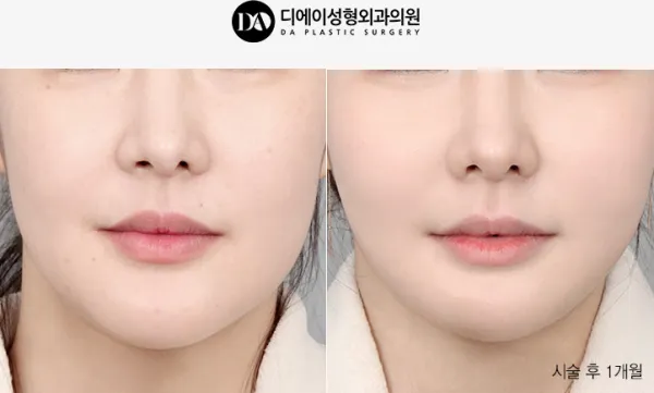 Before/After