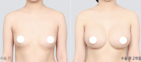 Before/After
