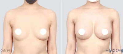 Before & After