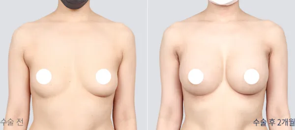 Before/After