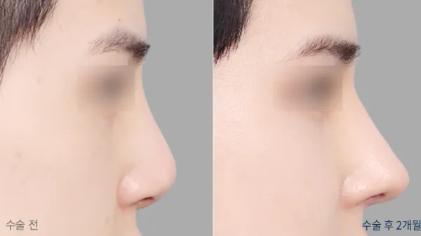 Before/After