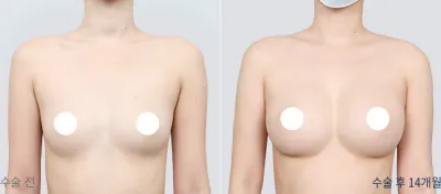 Before & After