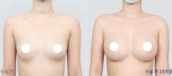 Before/After