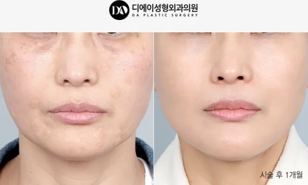 Before/After
