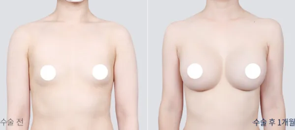 Before/After
