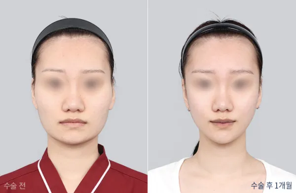 Before/After