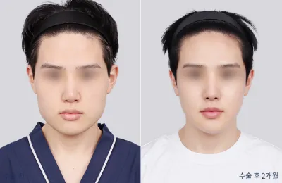 Before & After