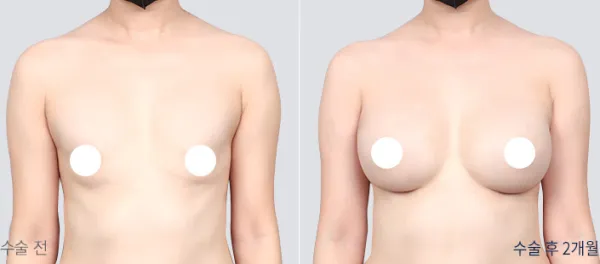 Before/After