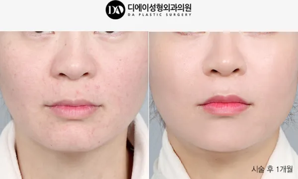 Before/After