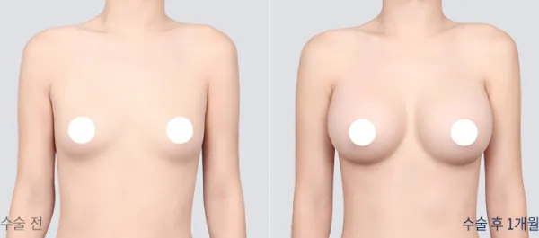 Before/After