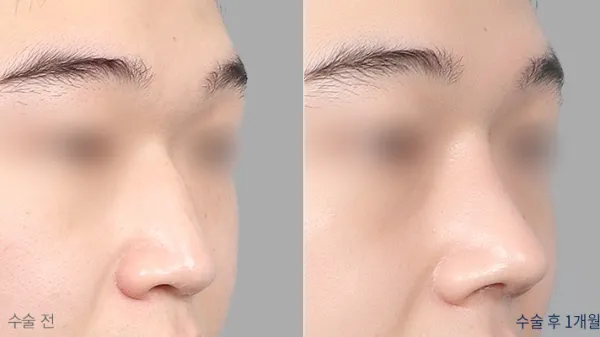 Before/After