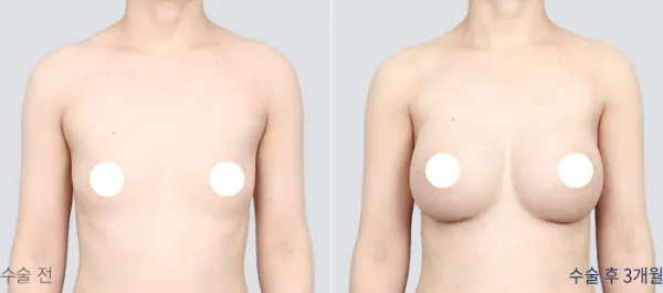 Before/After