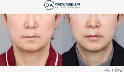 Before & After