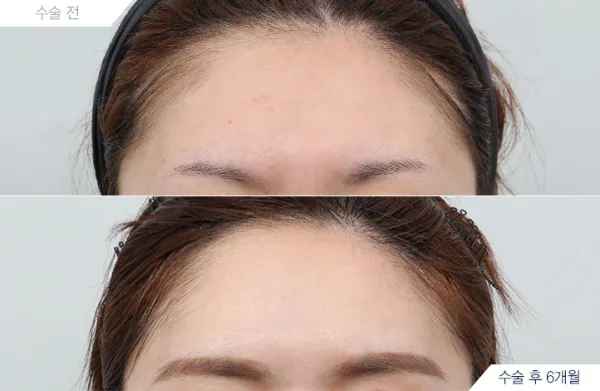Before/After