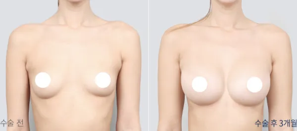 Before/After