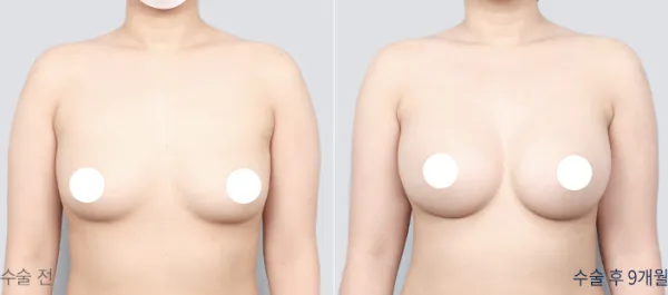 Before/After