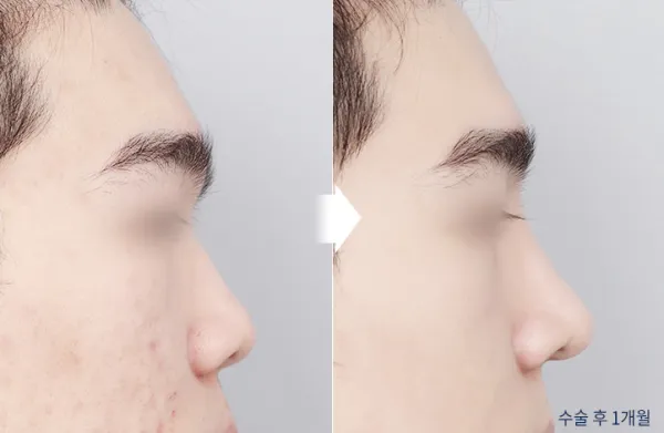 Before/After