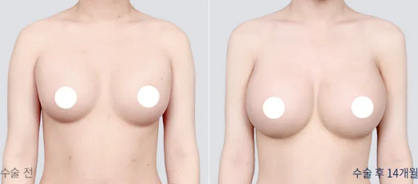 Before/After