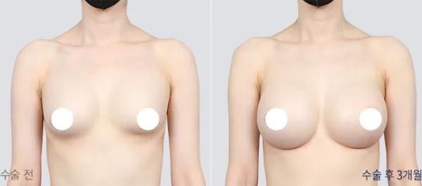 Before/After