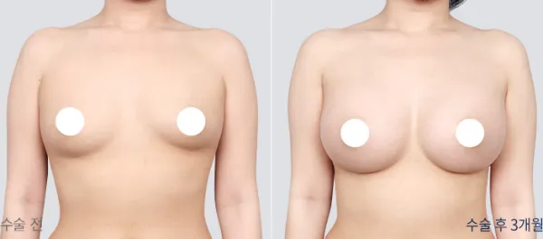 Before/After