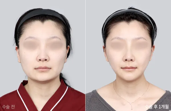 Before/After