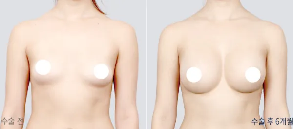 Before/After