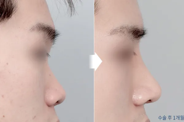 Before/After