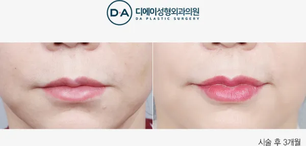 Before/After