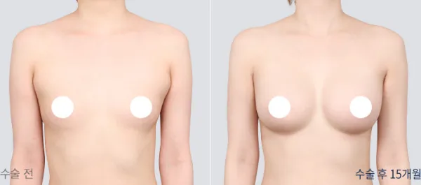 Before/After