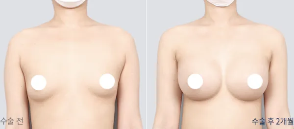 Before/After