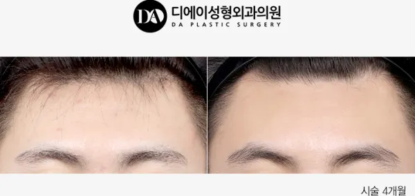 Before/After