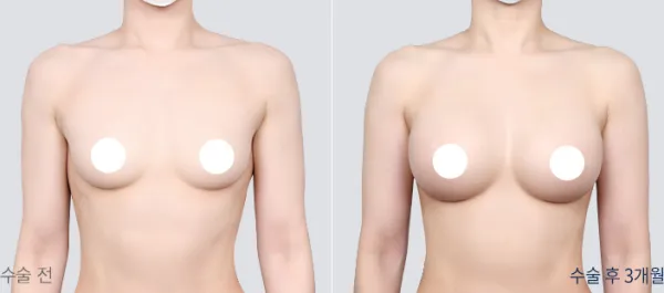 Before/After