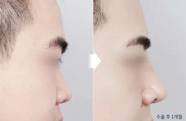 Before/After