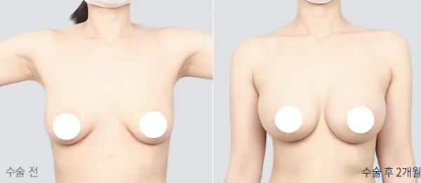 Before/After