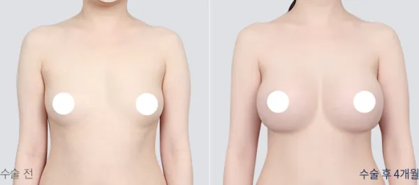 Before/After