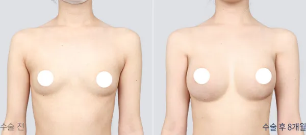 Before/After