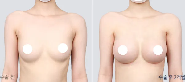 Before/After
