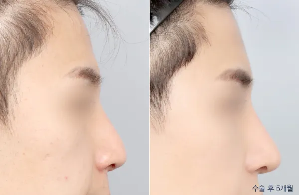 Before/After