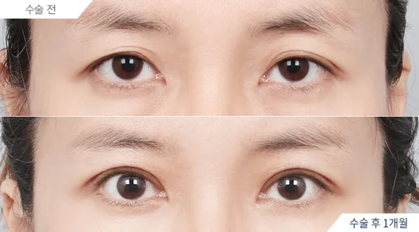 Before/After