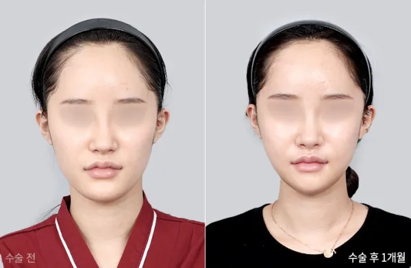 Before/After
