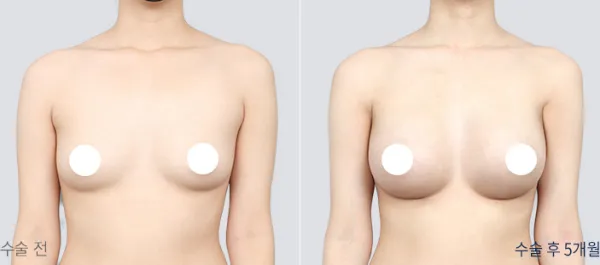 Before/After