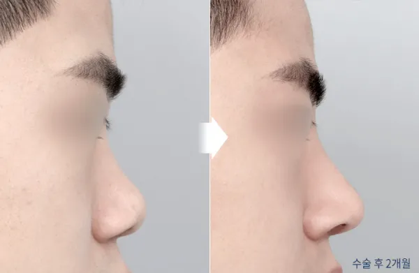 Before/After