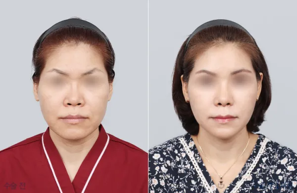 Before/After