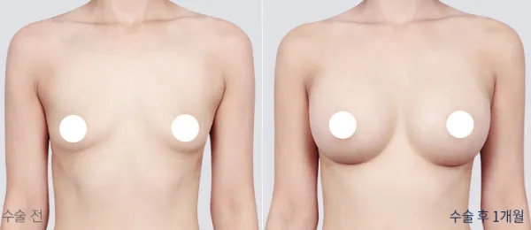 Before/After
